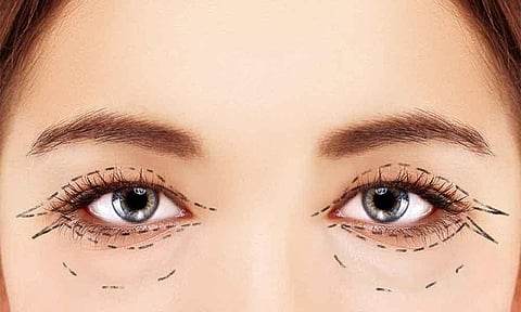 استشاري: عمليات تجميل الجفون آمنة بشرط 