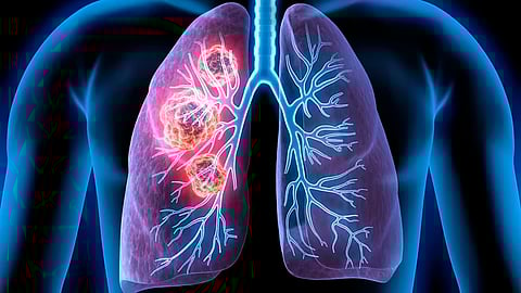 سعال دموي وضيق في التنفس.. تجمع الرياض الصحي يوضح أعراض الإصابة بسرطان الرئة