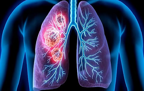 تجمع المدينة المنورة الصحي  يوضح حقائق حول سرطان الرئة