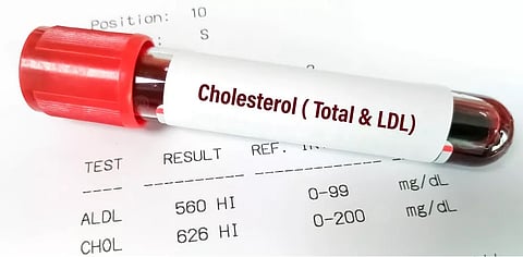 استشاري: مرضى القلب والضغط يجب أن يحافظوا على مستوى الكوليسترول الضار منخفض