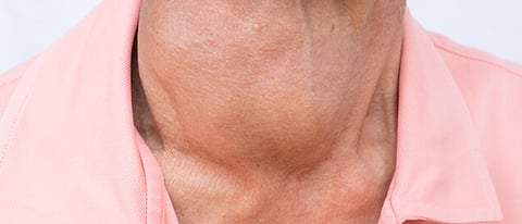 أستاذة بالطب توضح أثر اضطرابات الغدة الدرقية على الوزن