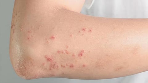 أخصائية: أعراض حساسية الطعام قد تظهر فجأة بدون مقدمات