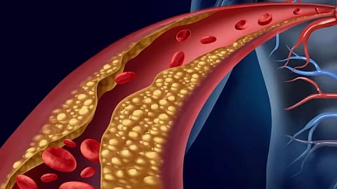 «فهد الطبية» توضح عوامل خطورة الإصابة بتصلب الشرايين والأمراض الناتجة عنه