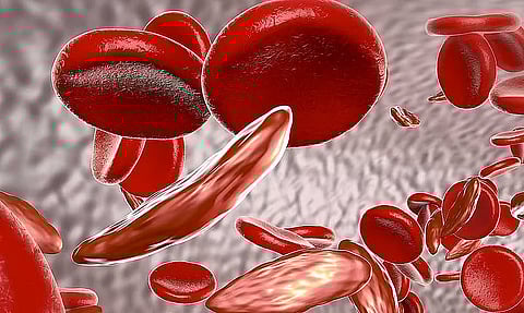 تجمع الرياض الصحي يوضح أعراض فقر الدم الناتج عن نقص الحديد وعلاجه