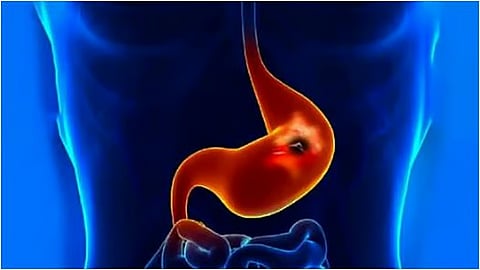 فقدان الوزن والشهية.. تعرف على أعراض جرثومة المعدة وطرق الوقاية منها