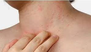 «الصحة العالمية»: حالة من بين كل خمس حالات إصابة بداء الدرن لا يتم اكتشافها