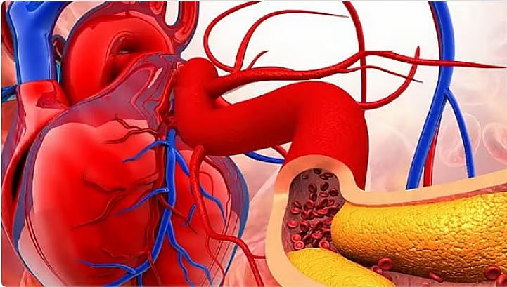 استشاري يوضح العلاقة بين أمراض اللثة وتصلب الشرايين