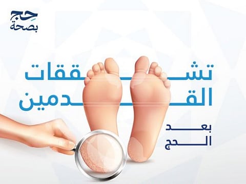 تشقق القدمين