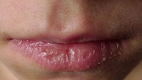 «استشارية جلدية» توضح أسباب تشقق وجفاف الشفاه وطرق العلاج