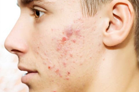 طبيعة وأشكال حَب الشباب الهرموني