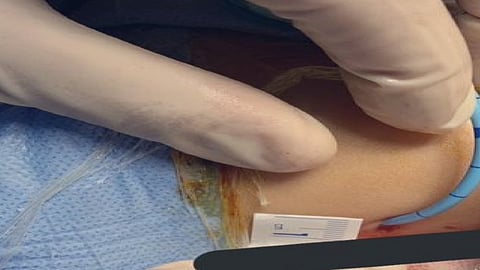 الأولى بالشرقية.. عملية جراحية معقدة لتفتيت حصوات بالكلى لطفل في الخبر