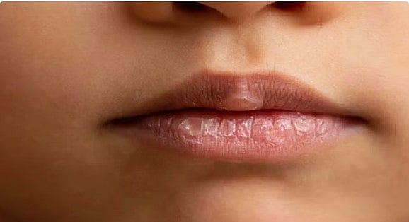 استشاري: 7 أسباب تؤدي إلى جفاف الفم 