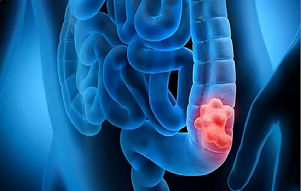 تجمع الرياض الصحي يوضح أسباب الإصابة بالقولون العصبي وطرق علاجه 