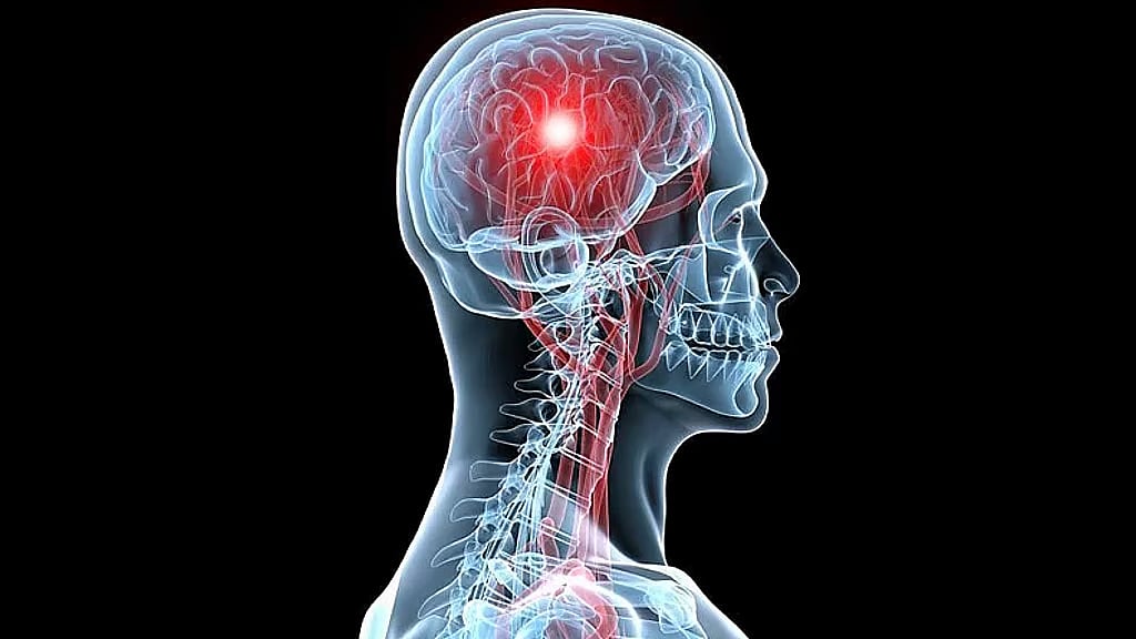 فهد الطبية توضح علامات الإصابة بالسكتة الدماغية 