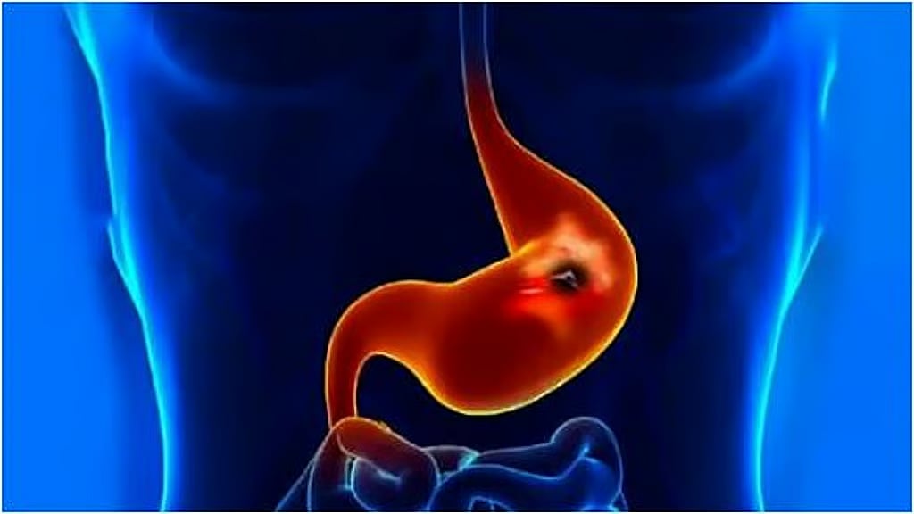 فقدان الوزن والشهية.. تعرف على أعراض جرثومة المعدة وطرق الوقاية منها 