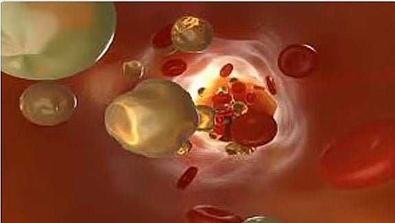 استشاري: ضعف الغدة الدرقية يؤدي الى ارتفاع الكوليسترول 