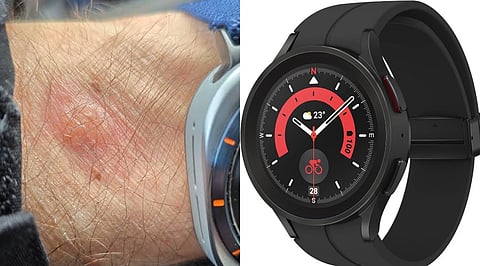 Galaxy Watch 5 Pro Owner Wakes Up to a Blister After Watch Allegedly Overheats Overnight; Samsung Has Not Acknowledged a Defect.
