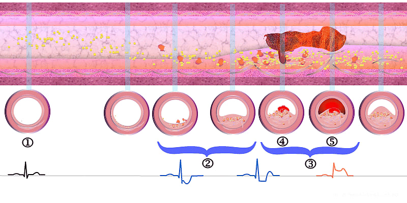 இதயத்துக்கு(ள்) இவ்வளவு சிக்கல்களா... 5 ஆண்டுகளில் 50% அதிகரிப்பு...!