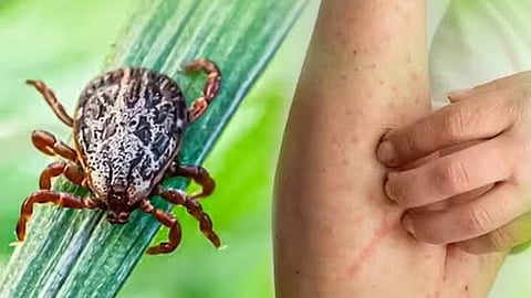 Scrub typhus
