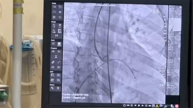 Bangladesh cuts costs of 22 types of heart stents