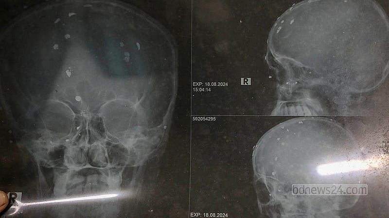 An X-ray image shows the skull of one of the injured, now receiving treatment at the National Institute of Traumatology and Orthopaedic Rehabilitation, or NITOR. Photo: Mahmud Zaman Ovi