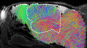 Lab-grown human brain tissue integrated into mice