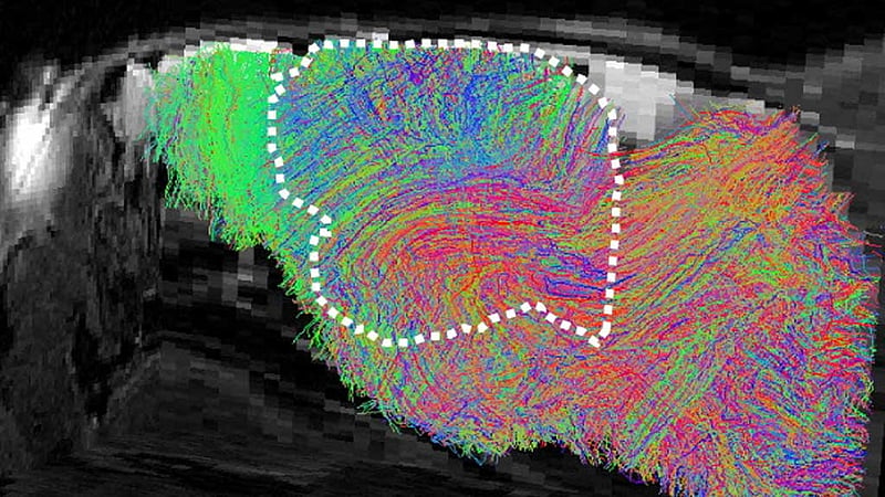 Scientists transplant lab-grown human brain tissue into mice