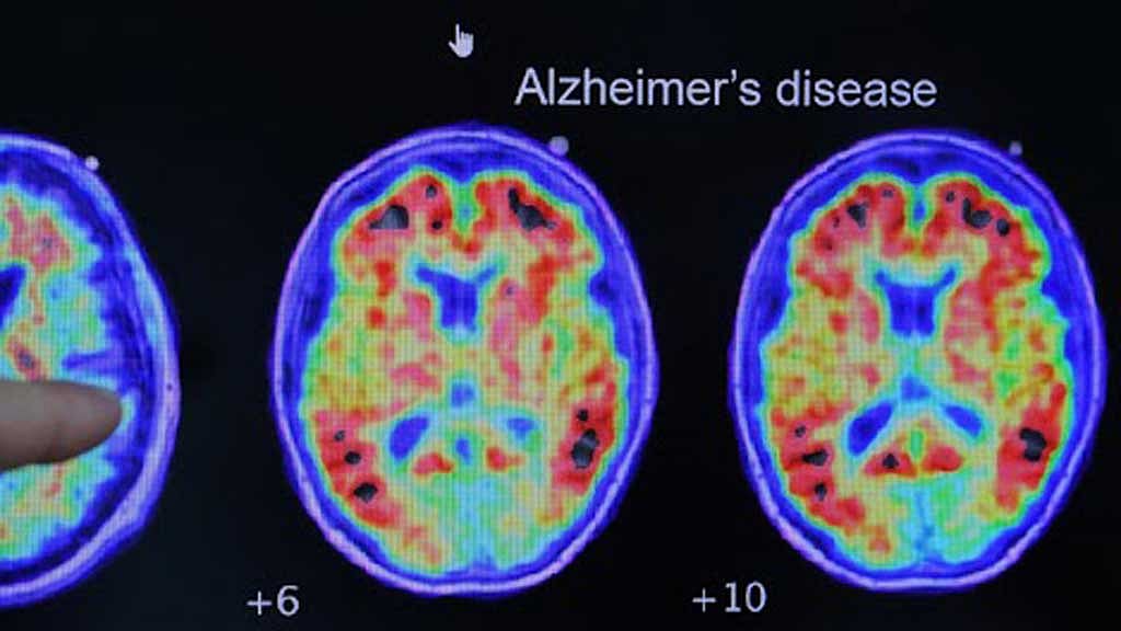 Have scientists found the missing link between Alzheimer's nerve damage and memory loss?