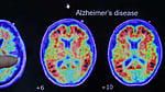 Have scientists found the root cause of Alzheimer's?