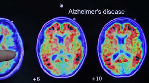 Have scientists found the root cause of Alzheimer's?