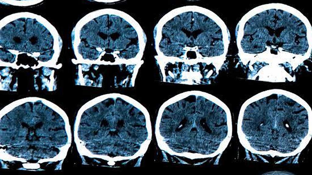 Brain cortex changes appear years before Alzheimer’s symptoms, study finds