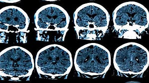MRI scans reveal brain changes years before Alzheimer’s: study