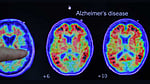 Alzheimer’s gene may scar brain’s blood vessels: study