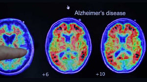 Alzheimer’s gene may scar brain’s blood vessels: study