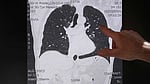 Lung adenocarcinoma: What is it, how is it treated?