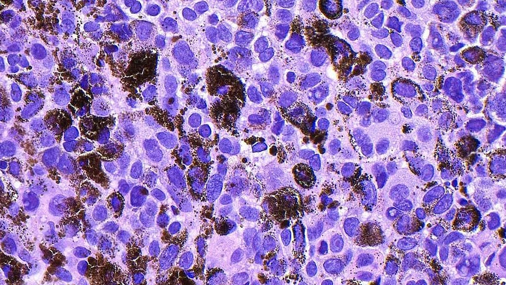 Personalised mRNA vaccine shows promise against melanoma in clinical trial
