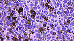 Experimental cancer vaccine shows promise in trial