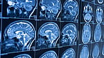 Brain implants translate brain signals into speech
