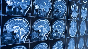 Brain implants translate brain signals into speech
