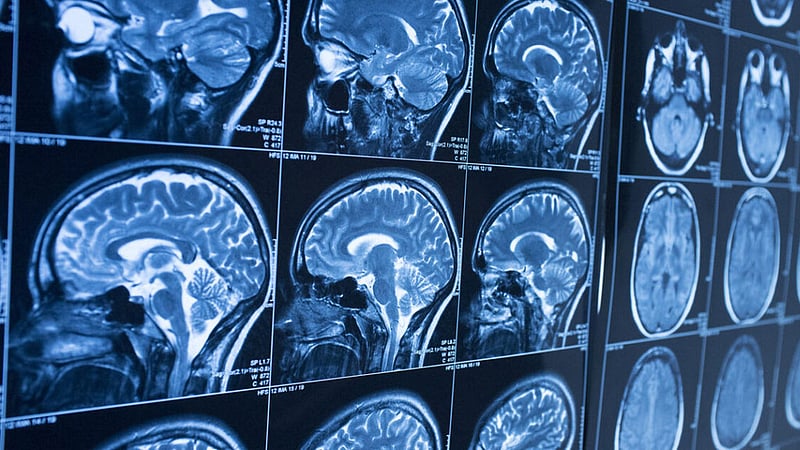 Brain implants translate brain signals into speech