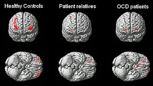 Scientists find genes linked to OCD, raising the prospect of new treatments