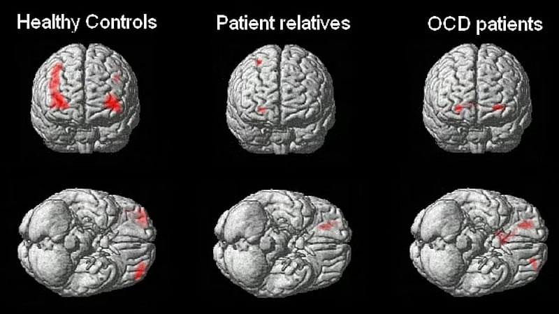 Scientists find genes linked to OCD, raising the prospect of new treatments