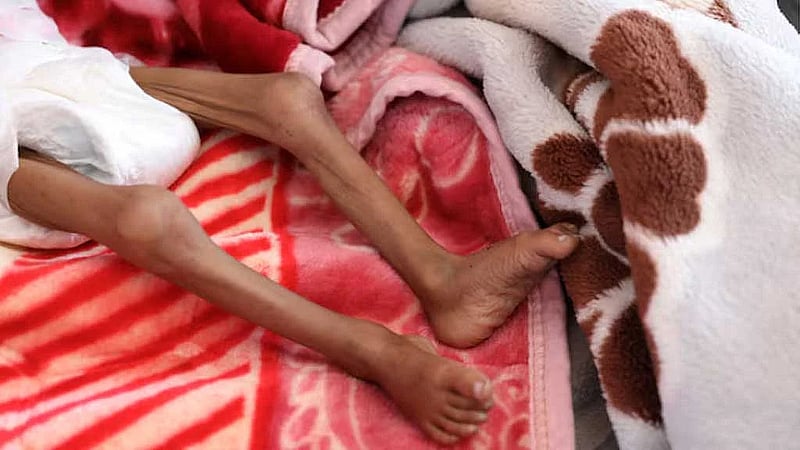 Urgent concern about malnutrition in Yemen after funding cuts, says MSF