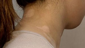বর্ষায় ছত্রাকের সংক্রমণ থেকে রক্ষা পেতে