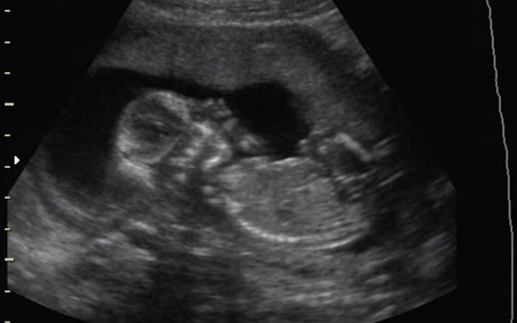 Boy or girl? Bangladesh High Court orders restrictions on foetal gender revelation