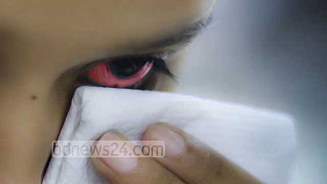 ‘চোখ ওঠা’ রোগে ভয় নয়, চাই সচেতনতা