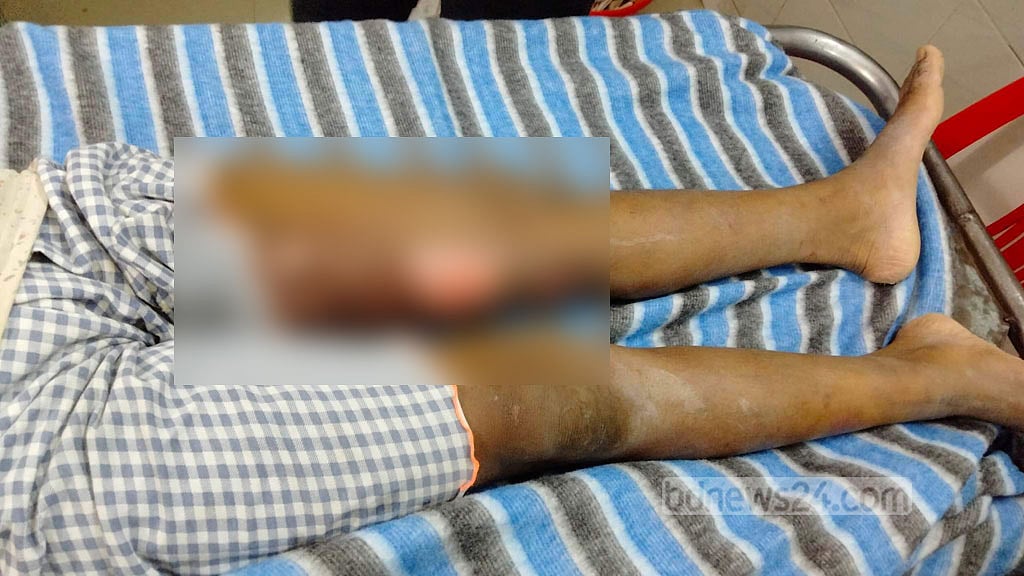 শিশু গৃহকর্মীকে ফুটন্ত পানি ঢেলে ‘নির্যাতন’, কুমিল্লায় সাবেক অধ্যক্ষের স্ত্রী আটক