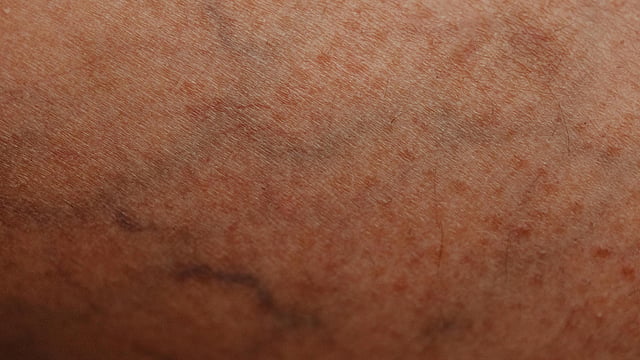 ত্বকে যদি দেখা দেয় লালচে শিরার ছোপ