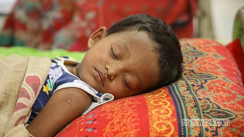 ঢাকার মুগদা মেডিকেল কলেজ হাসপাতালে চিকিৎসা নিচ্ছেন হামে আক্রান্ত শিশুরা