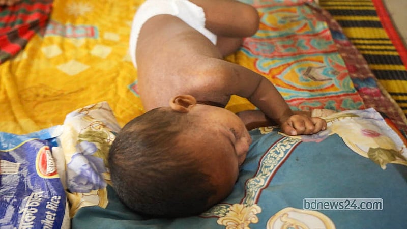 হবিগঞ্জ থেকে আসা হাম আক্রান্ত শিশু ইয়াসিন রাজধানীর মুগদা মেডিকেল কলেজ হাসপাতালে চিকিৎসা নিচ্ছেন